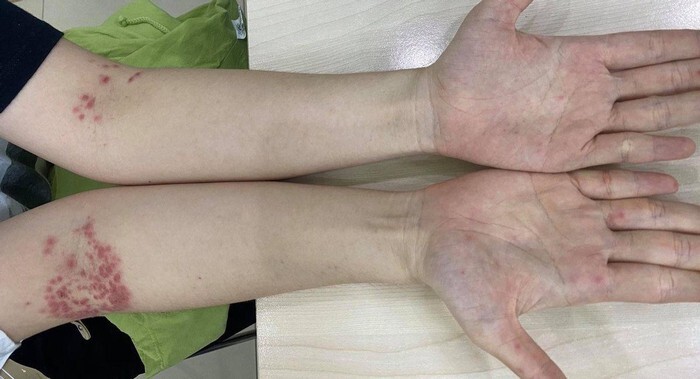 Tưởng bị bệnh chàm, người phụ nữ 32 tuổi phát hiện mắc bệnh tay chân miệng khi đi khám