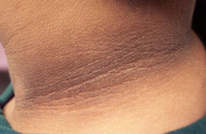 Cảnh báo căn bệnh nguy hiểm từ những dấu hiệu bất thường trên da