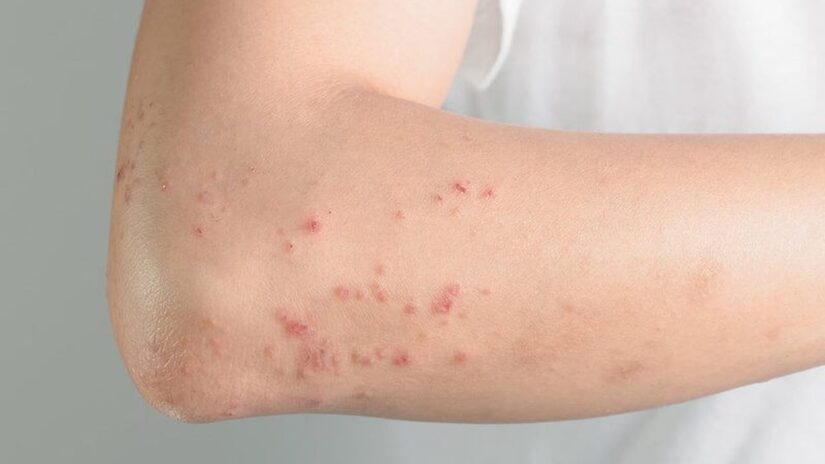 Cảnh báo căn bệnh nguy hiểm từ những dấu hiệu bất thường trên da