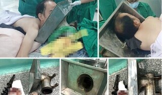 Bị cuốn cả cánh tay, nam thanh niên vác máy xay thịt vào viện cấp cứu