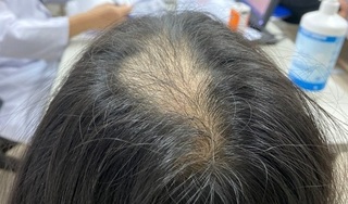 Bé gái 9 mắc chứng 'nghiện giật tóc' khiến đỉnh đầu trụi tóc