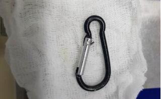 Bé 20 tháng tuổi nuốt móc chìa khóa vào trong dạ dày