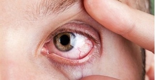 Vì sao lại đau mắt đỏ, điều trị thế nào?