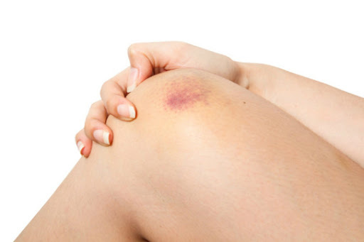 Cảnh báo căn bệnh nguy hiểm từ vết bầm tím trên da