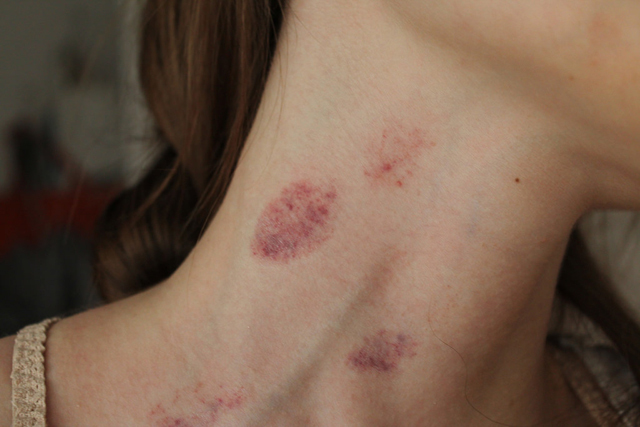 Cảnh báo căn bệnh nguy hiểm từ vết bầm tím trên da