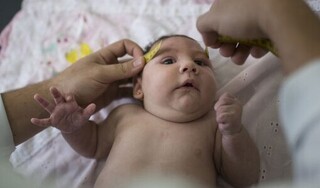 Tật đầu nhỏ ở trẻ sơ sinh: Nguyên nhân và cách điều trị
