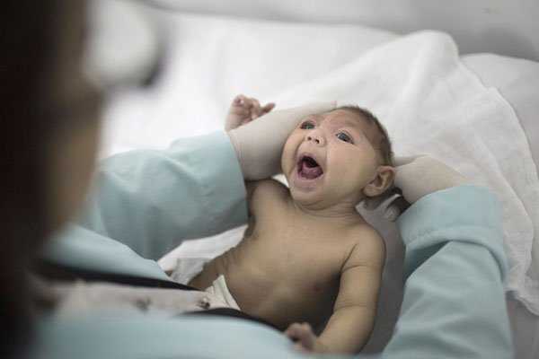 Tật đầu nhỏ ở trẻ sơ sinh, nguyên nhân và phương pháp điều trị