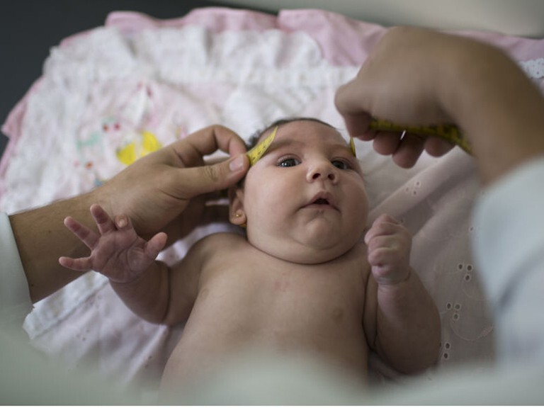 Tật đầu nhỏ ở trẻ sơ sinh, nguyên nhân và phương pháp điều trị