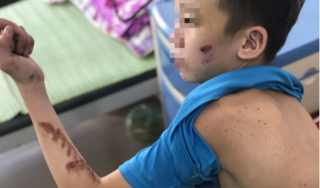 Bé trai bị chủ quán bánh xèo tra tấn: Dùng cối đá đập vào đầu, dí chảo chiên nóng vào tay