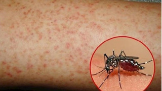 Những loại cây quen thuộc hỗ trợ phòng trị bệnh sốt xuất huyết hiệu quả