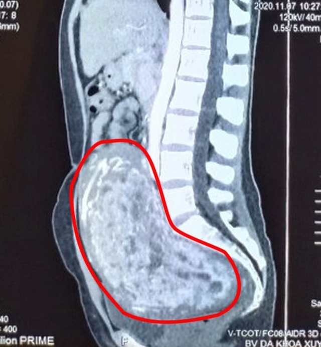 Đi khám do đau hông lưng bên phải, người phụ nữ phát hiện khối u khổng lồ chiếm trọn ổ bụng