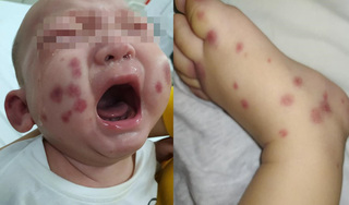 Bé 6 tháng tuổi bị đầy vết tím đen trên da, đâu là nguyên nhân?