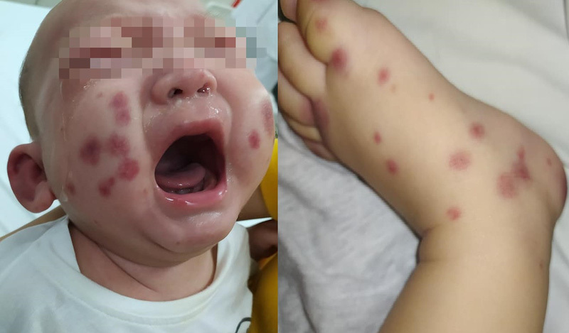Bác sĩ chỉ rõ nguyên nhân gây mảng xuất huyết tím đen trên da bé 6 tháng tuổi