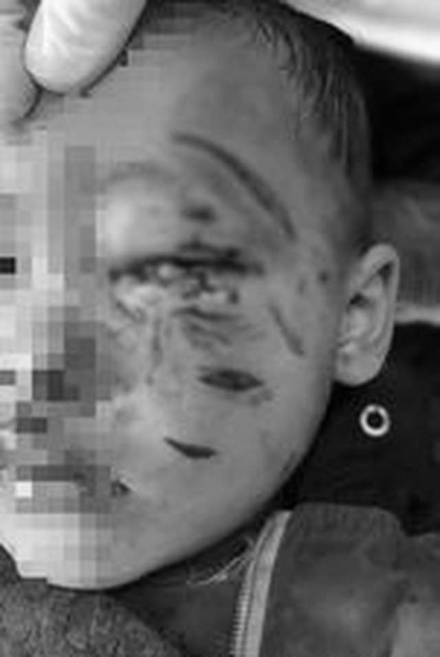 Bé trai 2 tuổi ở Nghệ An bị chó nhà cắn rách mặt, tổn thương mắt