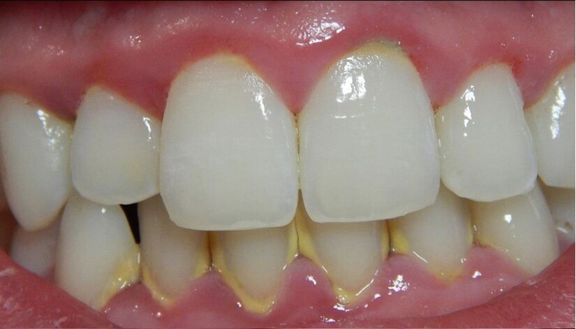 loại bỏ mảng bám răng