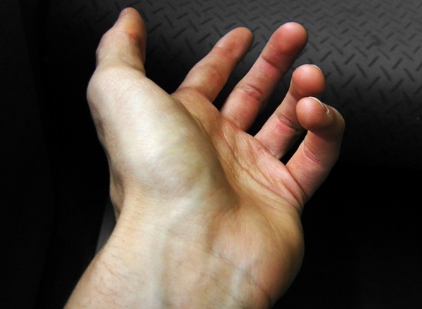 Gân xanh nổi ở tay chân báo hiệu điều gì về sức khỏe