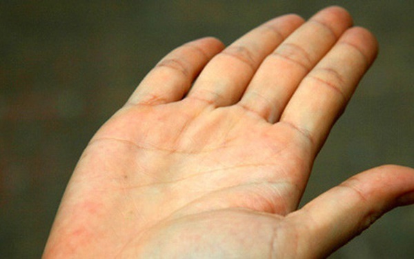 Gân xanh nổi ở tay chân báo hiệu điều gì về sức khỏe