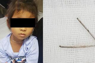 Cần Thơ: Một bé gái nuốt phải đoạn kim loại hình chữ V, dài 7 cm