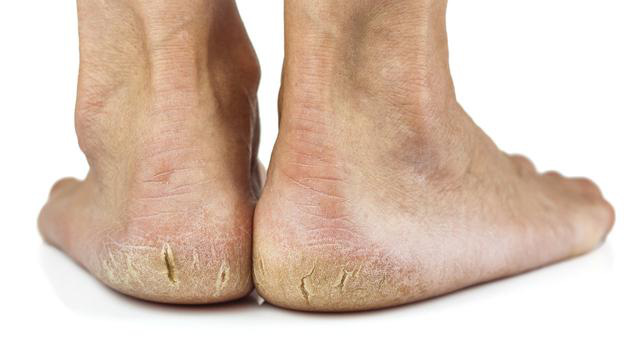 Gót chân thường xuyên bị khô và nứt nẻ, coi chừng sức khỏe đang kêu cứ