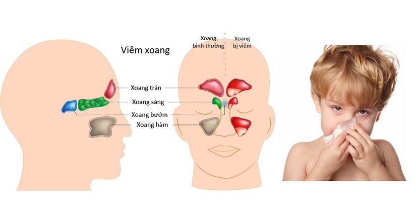 chữa ngạt mũi cho bé