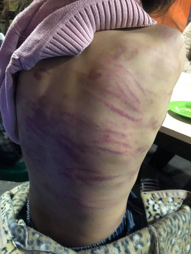 Hà Nội yêu cầu khẩn trương làm rõ vụ bé gái 12 tuổi ở Hà Đông nghi bị mẹ đẻ bạo hành dã man
