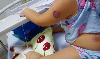 Bé gái 6 tuổi nhiễm vi khuẩn 'ăn thịt người' sau khi bị gà mổ vào chân