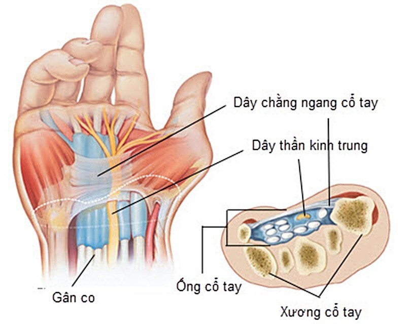 đau cổ tay