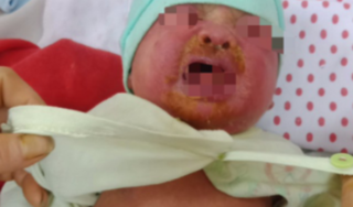 Bé 20 ngày tuổi nhiễm độc, toàn thân mẩn đỏ, mũi miệng viêm loét vì sai lầm của bố mẹ