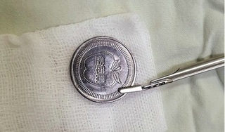 Bé trai 5 tuổi bị mắc kẹt đồng xu ở thực quản