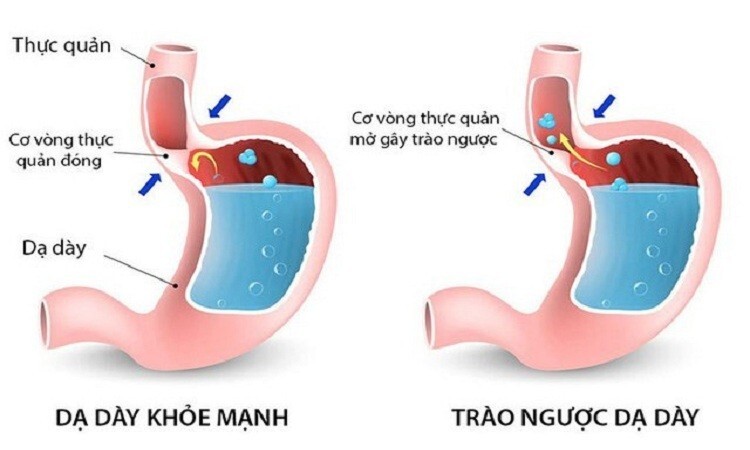 trào ngược dạ dày