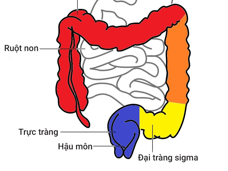 viêm đại tràng sigma 