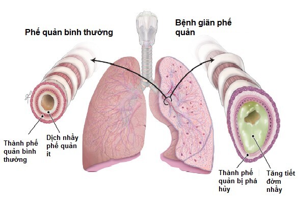 Ho có đờm xanh