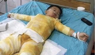Ngã vào nồi canh, bé trai 3 tuổi bị bỏng nặng nguy kịch khi gia đình khó khăn