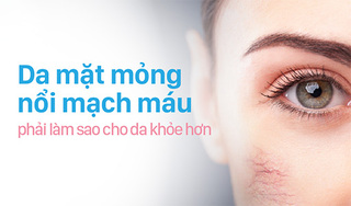 Da mặt mỏng nổi mạch máu phải làm sao cho da khỏe hơn?