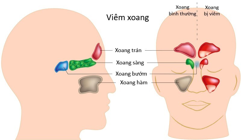 viêm xoang gây ho