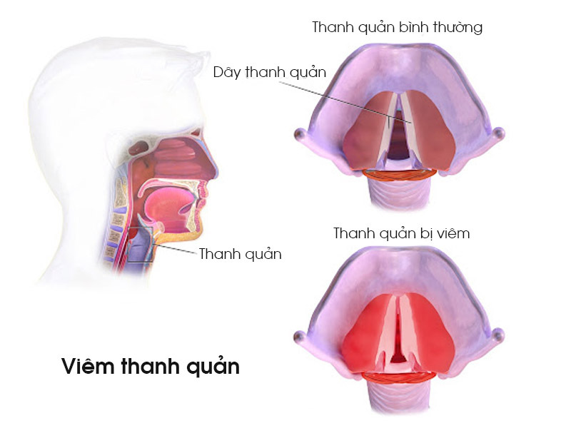 viêm thanh quản mãn tính