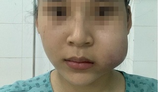 Cô gái bị biến dạng mặt nghiêm trọng sau khi tiêm filler