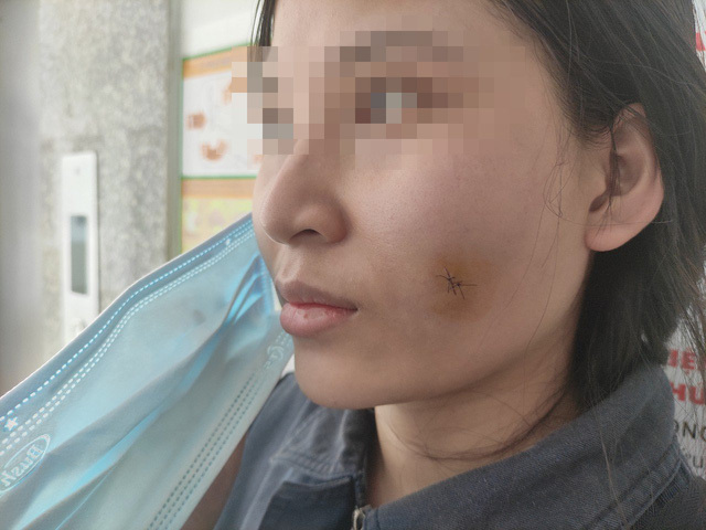 Cô gái bị nhiễm trùng, áp xe má sau khi tiêm filler tạo khuôn mặt đầy đặn