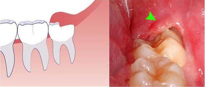 viêm lợi trùm