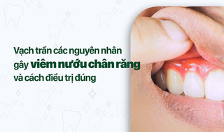 'Vạch trần' các nguyên nhân gây viêm nướu chân răng và cách điều trị