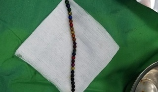 Bé trai 3 tuổi nuốt 25 viên bi nam châm đồ chơi vào bụng