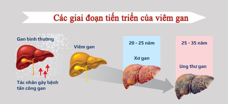 bệnh viêm gan b có nguy hiểm không