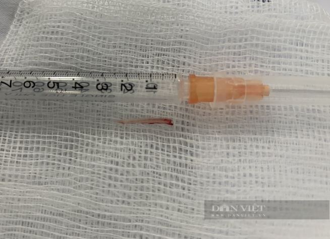 Bé trai 3 tuổi bị hóc xương cá, đâm vào vị trí hiểm