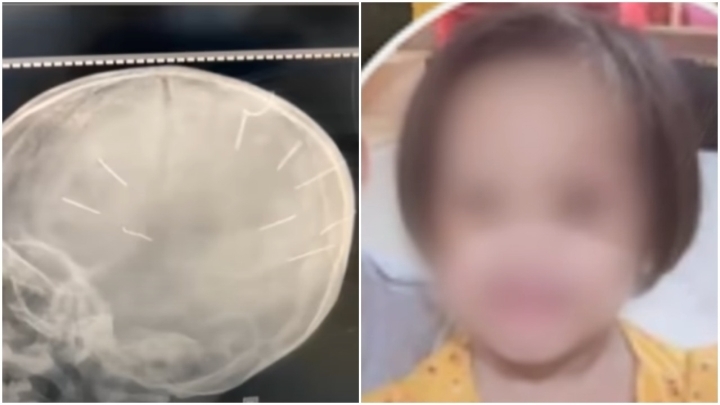 Bắt khẩn cấp kẻ đóng 9 đinh vào đầu bé gái 3 tuổi ở Hà Nội 