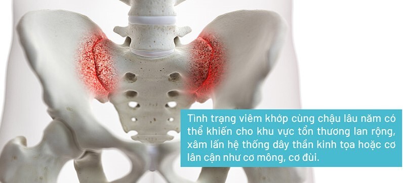 Viêm khớp cùng chậu