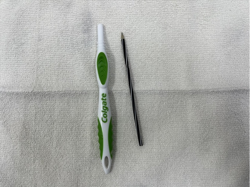 Bàn chải đánh răng, ruột bút bi trong dạ dày bệnh nhân 23 tuổi