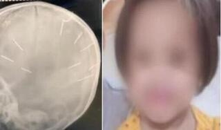 Khám nghiệm tử thi, phát hiện 10 chiếc đinh trong đầu bé gái 3 tuổi tử vong