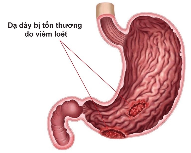 Chướng bụng đầy hơi