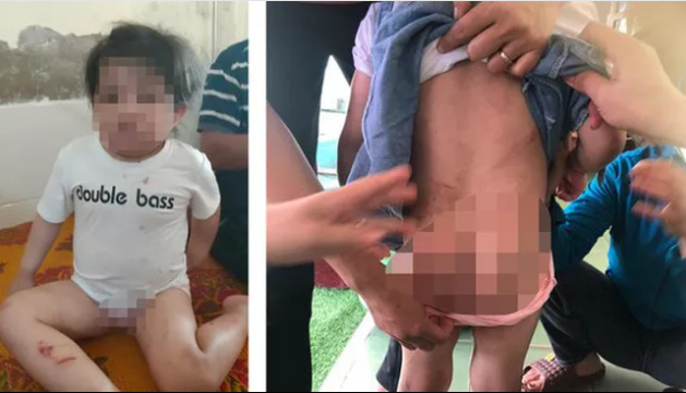 Phẫn nộ nguyên nhân bé gái 4 tuổi bị dì ruột đánh thương tích khắp người