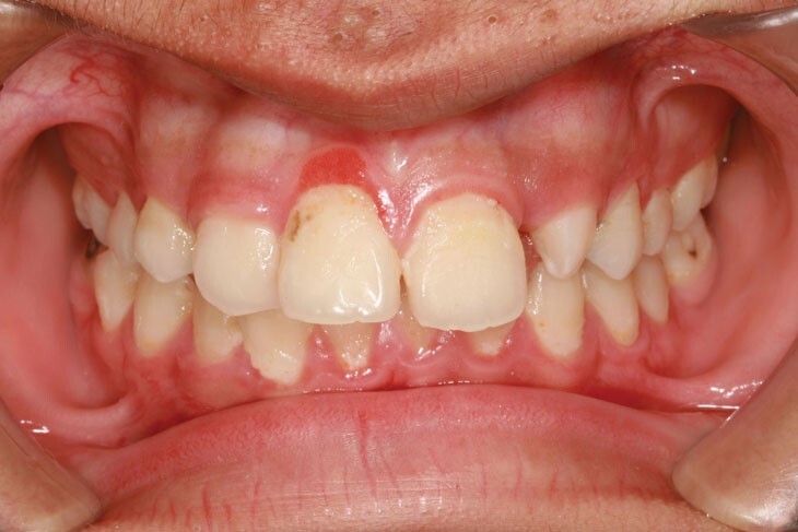 viêm lợi viêm chân răng